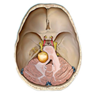 Schwannoma vestibular