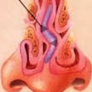 Septoplastía