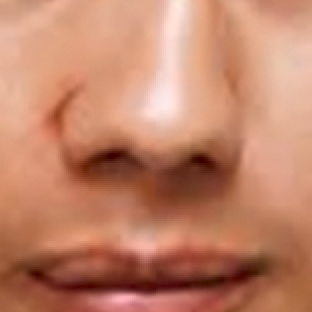 Trauma nasal